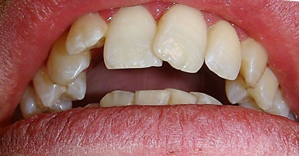 Zahnstellungskorrektur mit Zahnspange Invisalign