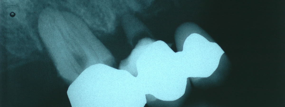 Röntgenbild - Genaue Diagnose der Karies rettet vor einer kostenintensiver Wurzelbehnadlung